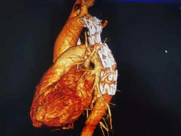 打疫苗意外發現自己的“超高血壓”，專家：這種病隱匿又危險