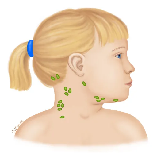 孩子脖子上摸到包塊，警惕淋巴結異常腫大