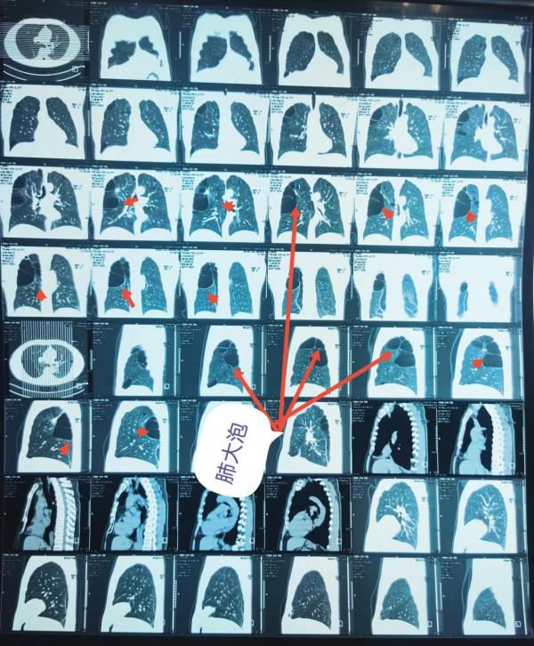 肺大泡相關（診治）問題