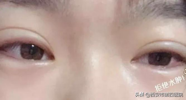 #安心變美課堂##我的安心變美推薦# 眼皮越來越松，怎麼辦？