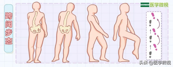 1萬人中有4人，小腿會悄悄變“瘦”，但希望不是你