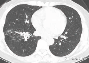 咳嗽半年反覆肺炎為什麼治不好 細看影像發現端倪緣是異物堵塞
