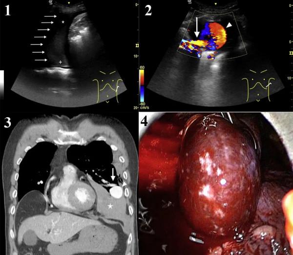 肺動靜脈畸形破裂致血胸