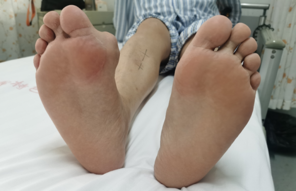 痛風15年不忌口，右腳長滿痛風石！日常3注意，把尿酸“治”服帖