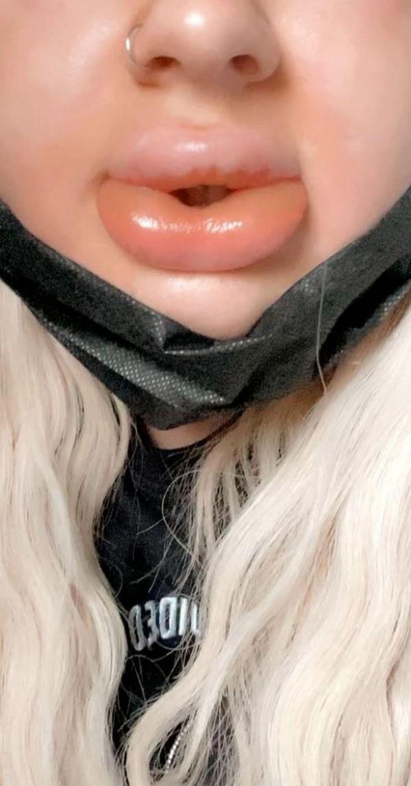 英國24歲女子第一次豐唇腫成&OpenCurlyDoubleQuote;香腸嘴&rdquo;，填充物膨脹到原來的20倍