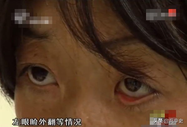 真實故事：山東女娃被開水燙成“鬼臉”，24歲結婚後又慘遭家暴