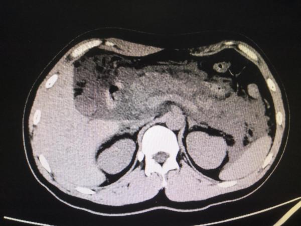 又是熟人惹的禍,急性出血性胰腺炎 又是熟人惹的禍,急性出血性胰腺炎