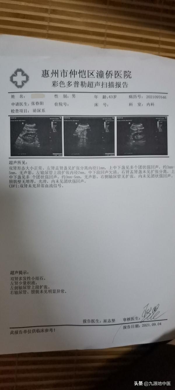 腎結石是常見病,看看中醫怎麼治好的,有B超對比為證 腎結石是常見病,看看中醫怎麼治好的,有B超對比為證