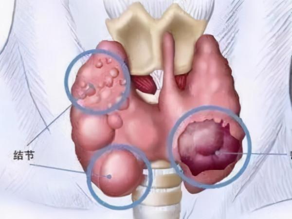 這4種“發物”，體內有“結節”的人，儘量少吃，別不聽勸