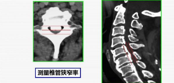 頸椎後縱韌帶骨化症
