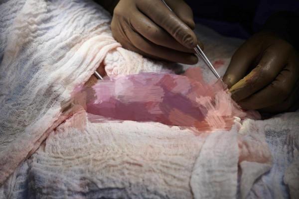 歷史性突破!美國大學給腦死亡病人移植豬腎臟,腎臟工作54小時 歷史性突破!美國大學給腦死亡病人移植豬腎臟,腎臟工作54小時