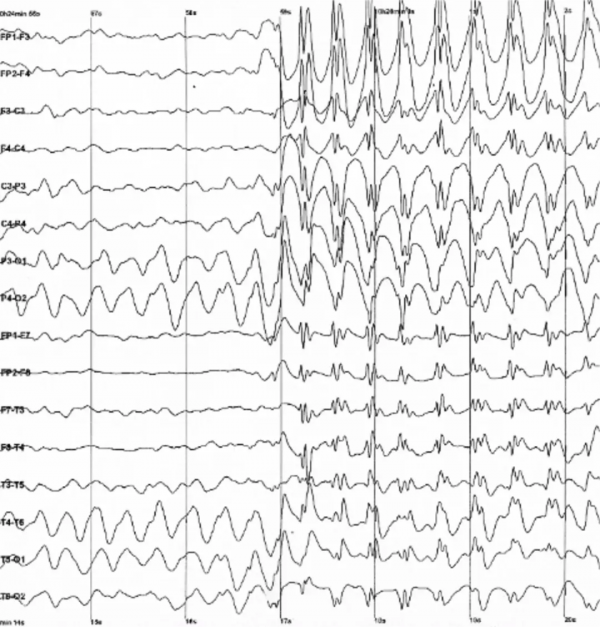 用機器學習和神經科學解碼大腦訊號