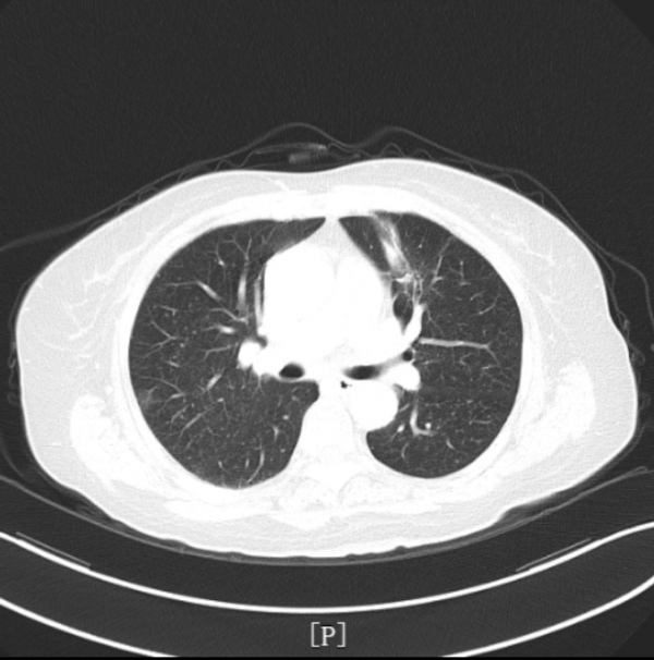 百例徵優 | 貝伐珠單抗聯合化療——為晚期肺癌多發轉移患者帶來新希望