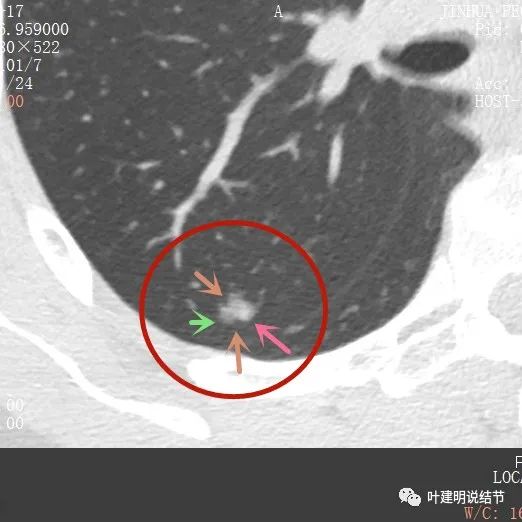 指南說小於5毫米的肺結節不需要隨訪，打臉來了