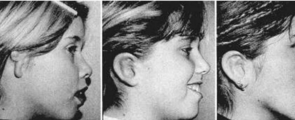 小耳畸形科普:用自體軟骨支架造的耳朵會繼續生長嗎? 小耳畸形科普:用自體軟骨支架造的耳朵會繼續生長嗎?