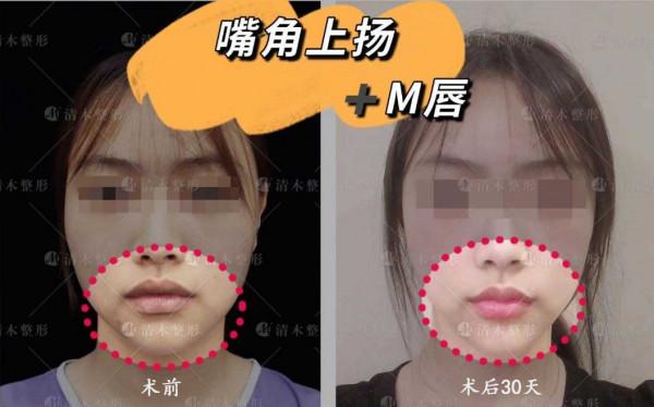 嘴角上揚＋M唇 | 30天效果對比
