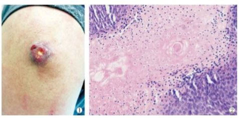 小孩臉上有個“包”，不是蚊子咬，警惕是這種疾病