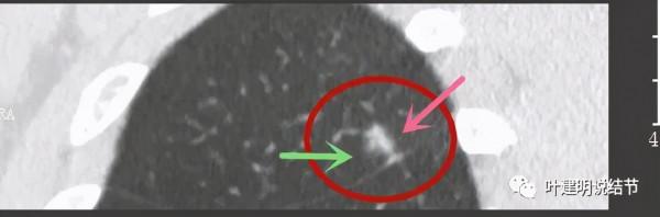 指南說小於5毫米的肺結節不需要隨訪，打臉來了