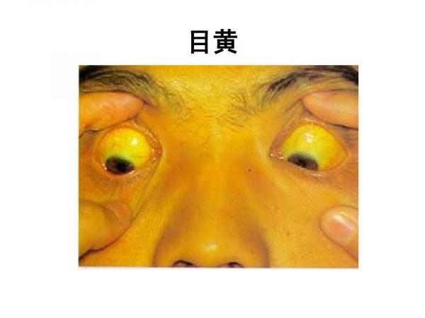 胰腺癌沒有肺癌的患者人群多，但是為什麼還叫癌中之王呢？