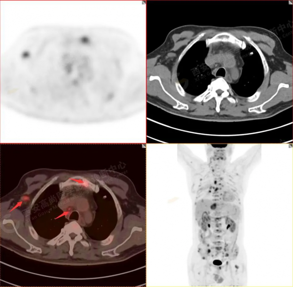 肺結節看診（13）：肺小結節全身廣泛轉移2例，PET分期：晚期