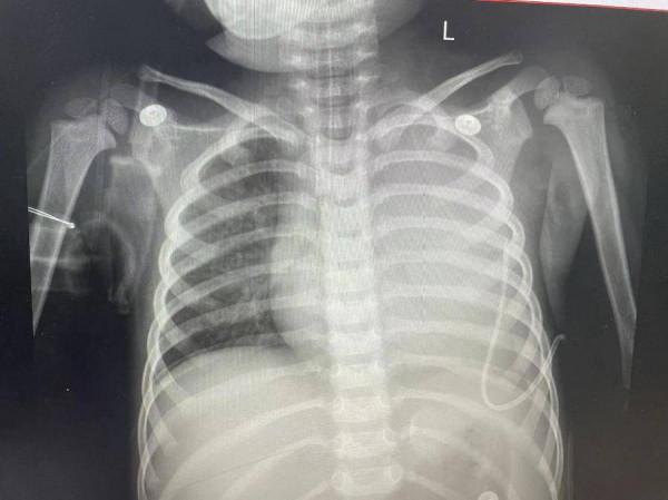 肺炎當感冒拖成“重症”,醫生:孩子出現這些情況要注意 肺炎當感冒拖成“重症”,醫生:孩子出現這些情況要注意