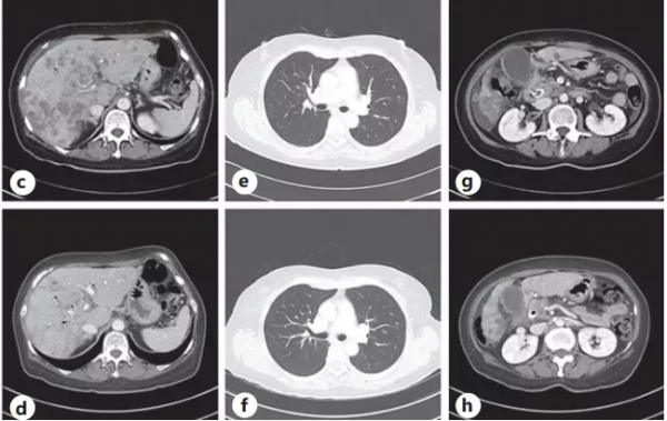 脂質體伊立替康耐藥了竟然還可以再用