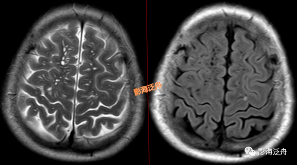 VR腔隙、腔梗灶、微出血、脫髓鞘，傻傻分不清？快看這裡