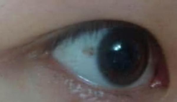 孩子眼白有“黑點”，需要治療嗎？