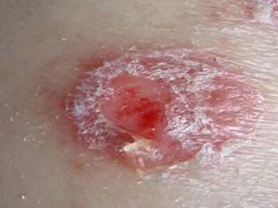 人們不要把二期梅毒“銀屑病樣疹”,誤認為銀屑病 人們不要把二期梅毒“銀屑病樣疹”,誤認為銀屑病