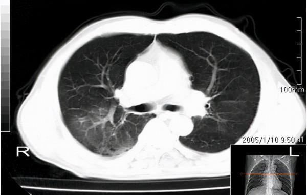 氣管鏡檢查能確診肺結核嗎?檢查前有哪些注意事項呢? 氣管鏡檢查能確診肺結核嗎?檢查前有哪些注意事項呢?