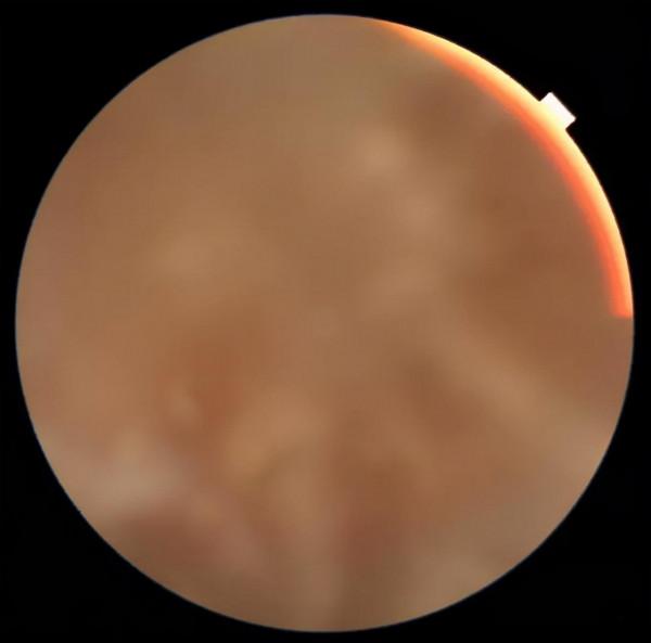 醫心向黨 醫心為民丨患者左眼失明多年 專家仁心妙手回春