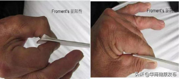 手麻！不可忽視的另一病因