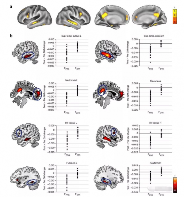 國外研究:懷孕會改變大腦!“孕傻”是真的?真相和你想的不一樣 國外研究:懷孕會改變大腦!“孕傻”是真的?真相和你想的不一樣