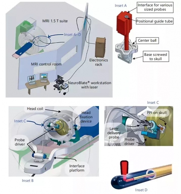 不用開顱的LITT鐳射間質熱療，治腦瘤真的有效嗎？最新臨床資料