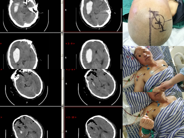 家人突發腦出血咋辦？醫生教你家庭急救辦法，家人有高血壓的請看
