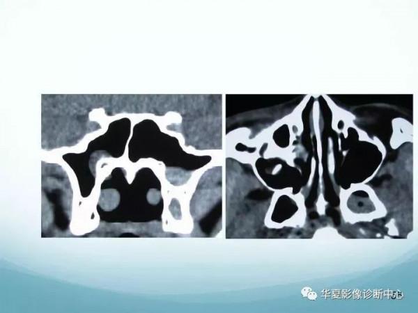 頭頸五官CT斷層解剖圖及常見病影像診斷