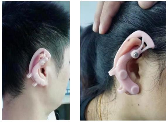 耳穴治療能幫助生小孩？專家揭秘&srarr;