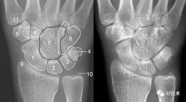 贊！腕關節X線高畫質解剖+腕骨脫位典型病例