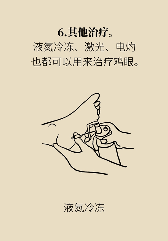 長了雞眼和老繭怎麼辦？這份防治指南請收好