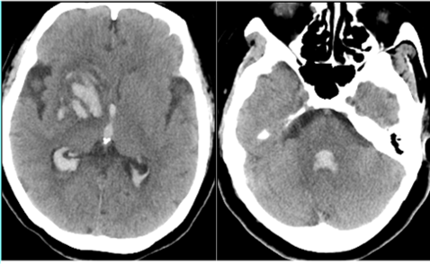 腦動靜脈畸形影像學特徵