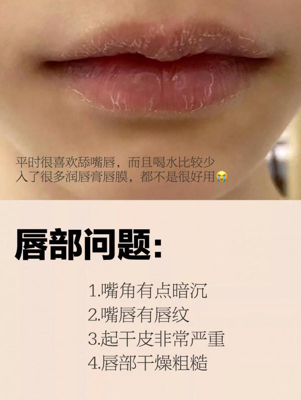 不能忽視的嘴唇護理丨唇部問題乾貨分享
