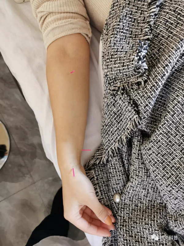 脈診針灸治療咳嗽案例一則 脈診針灸治療咳嗽案例一則