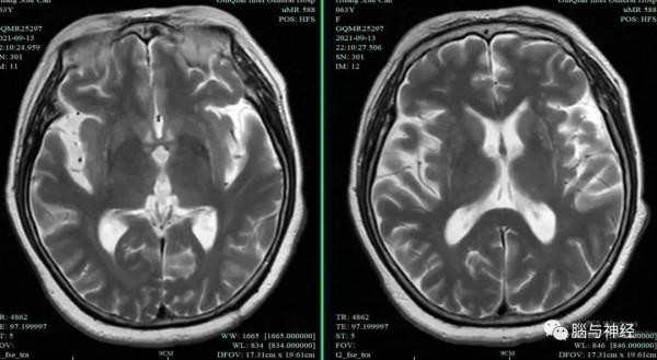 多系統萎縮，我是得了帕金森病嗎？