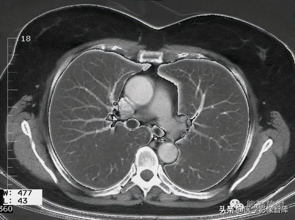 CT斷層解剖圖譜最全總結「推薦收藏」 CT斷層解剖圖譜最全總結「推薦收藏」