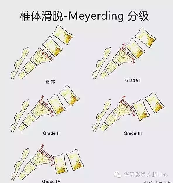 骶椎腰化/腰椎骶化、腰椎滑脫、腰肌勞損，簡單易懂圖解
