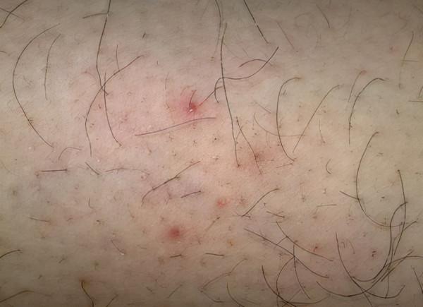 毛囊發炎是怎麼回事？要忌口嗎？