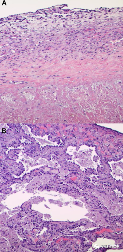 62歲男性患者呼吸急促、乾咳3個月，卻被誤診3個月，這樣的事件你能接受嗎？
