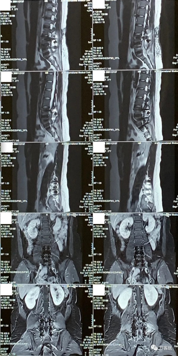 27歲女性，兩間隙腰椎間盤突出症，6顆釘子，4個融合器