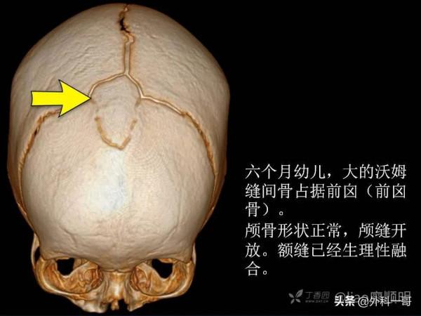 小兒顱縫早閉的診斷治療