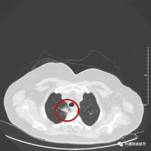 這種肺部多發磨玻璃影會是啥?我突然想到上次分析過的一種罕見病 這種肺部多發磨玻璃影會是啥?我突然想到上次分析過的一種罕見病